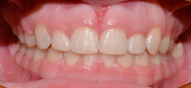 before and after