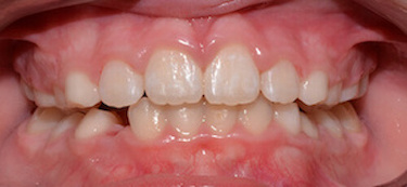 before and after