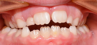 before and after