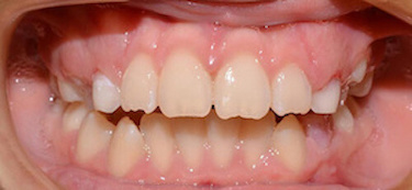 before and after
