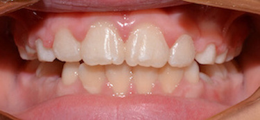before and after