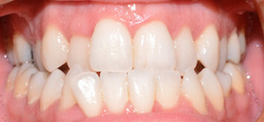 before and after
