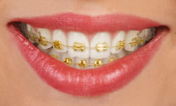 invisalign
